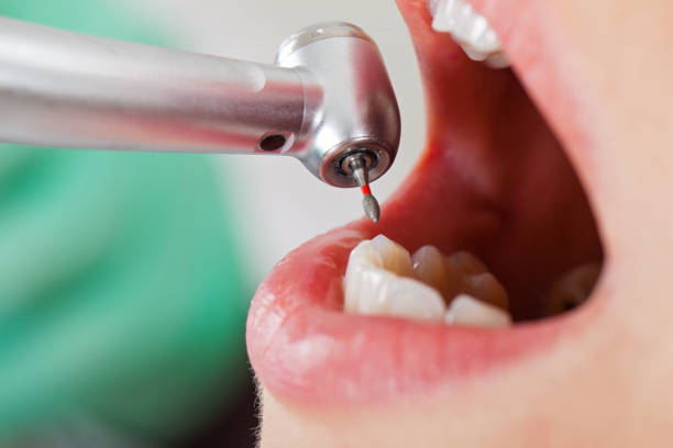Best Lost Filling or Crown Replacement in Oregon, WI